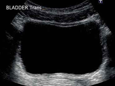 bladder-ts-normal.jpg